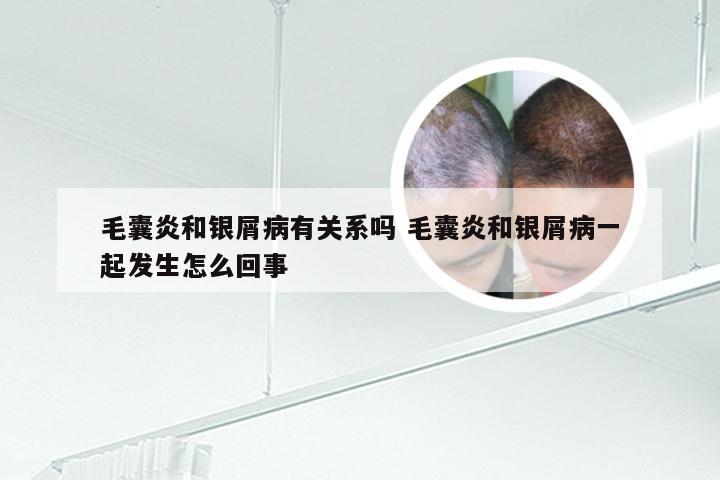 毛囊炎和银屑病有关系吗 毛囊炎和银屑病一起发生怎么回事