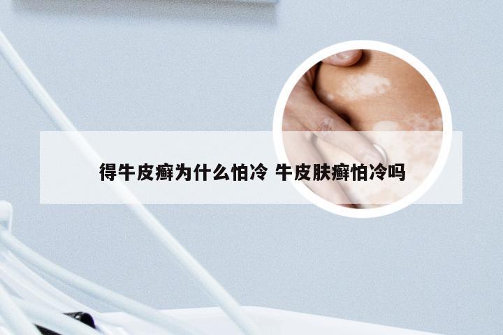 得牛皮癣为什么怕冷 牛皮肤癣怕冷吗