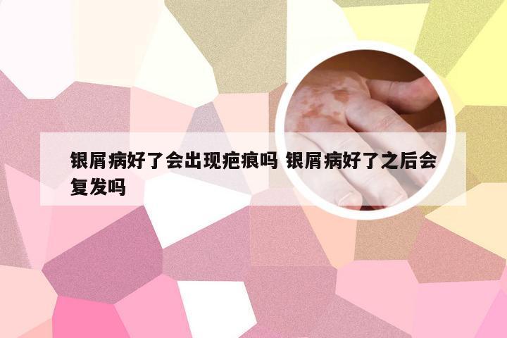 银屑病好了会出现疤痕吗 银屑病好了之后会复发吗