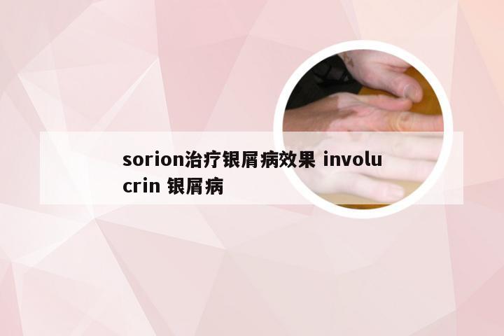 sorion治疗银屑病效果 involucrin 银屑病