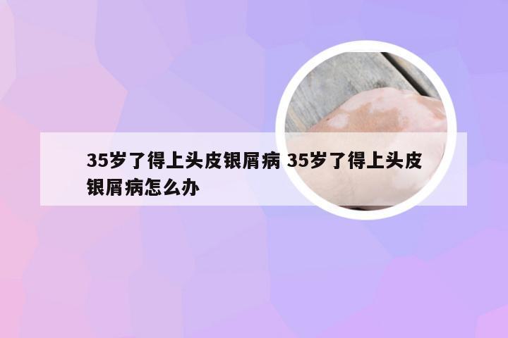 35岁了得上头皮银屑病 35岁了得上头皮银屑病怎么办