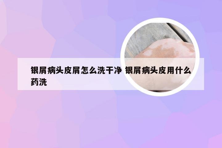 银屑病头皮屑怎么洗干净 银屑病头皮用什么药洗