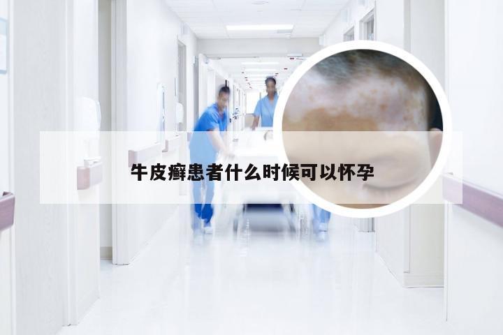 牛皮癣患者什么时候可以怀孕