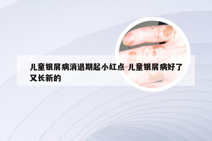 儿童银屑病消退期起小红点 儿童银屑病好了又长新的