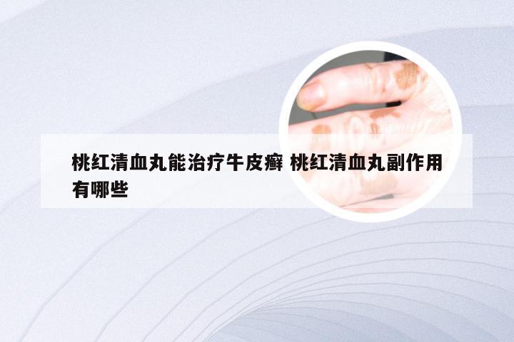 桃红清血丸能治疗牛皮癣 桃红清血丸副作用有哪些