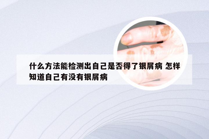 什么方法能检测出自己是否得了银屑病 怎样知道自己有没有银屑病