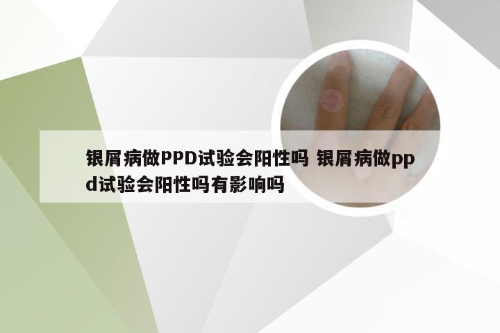 银屑病做PPD试验会阳性吗 银屑病做ppd试验会阳性吗有影响吗