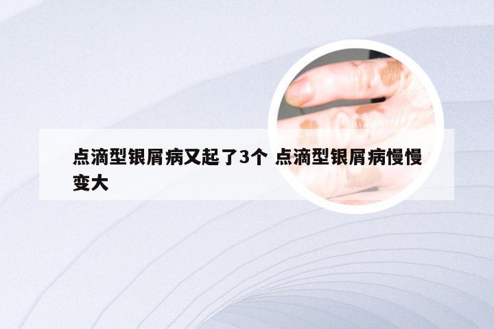 点滴型银屑病又起了3个 点滴型银屑病慢慢变大