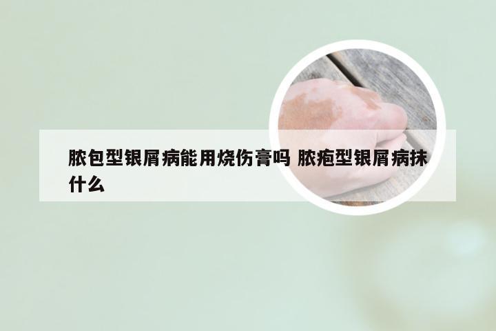 脓包型银屑病能用烧伤膏吗 脓疱型银屑病抹什么