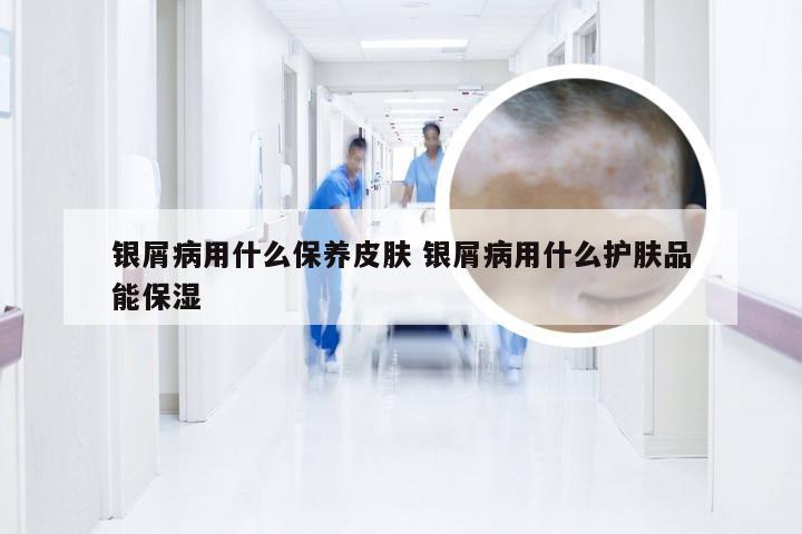 银屑病用什么保养皮肤 银屑病用什么护肤品能保湿