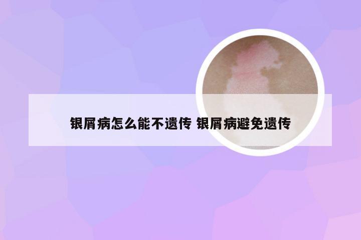 银屑病怎么能不遗传 银屑病避免遗传