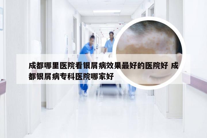 成都哪里医院看银屑病效果最好的医院好 成都银屑病专科医院哪家好