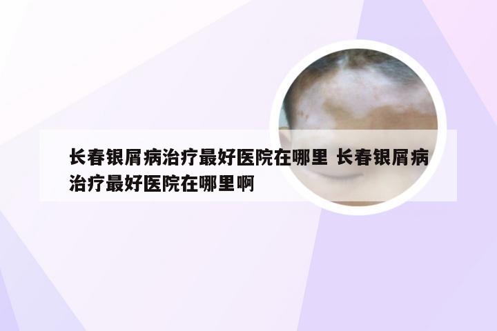 长春银屑病治疗最好医院在哪里 长春银屑病治疗最好医院在哪里啊