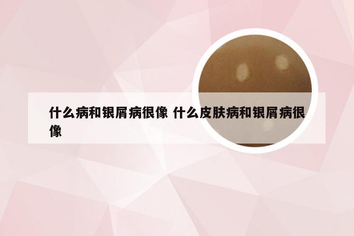 什么病和银屑病很像 什么皮肤病和银屑病很像