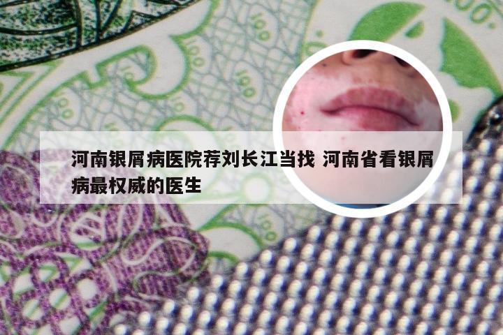 河南银屑病医院荐刘长江当找 河南省看银屑病最权威的医生