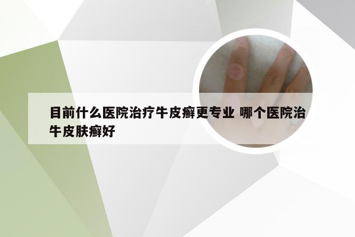 目前什么医院治疗牛皮癣更专业 哪个医院治牛皮肤癣好