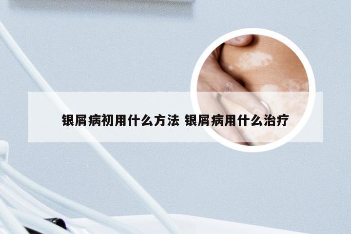 银屑病初用什么方法 银屑病用什么治疗