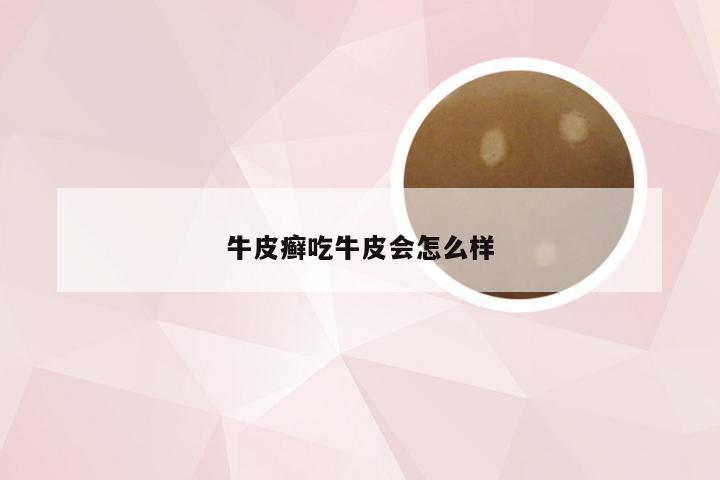 牛皮癣吃牛皮会怎么样