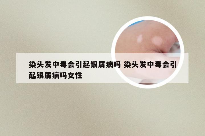 染头发中毒会引起银屑病吗 染头发中毒会引起银屑病吗女性