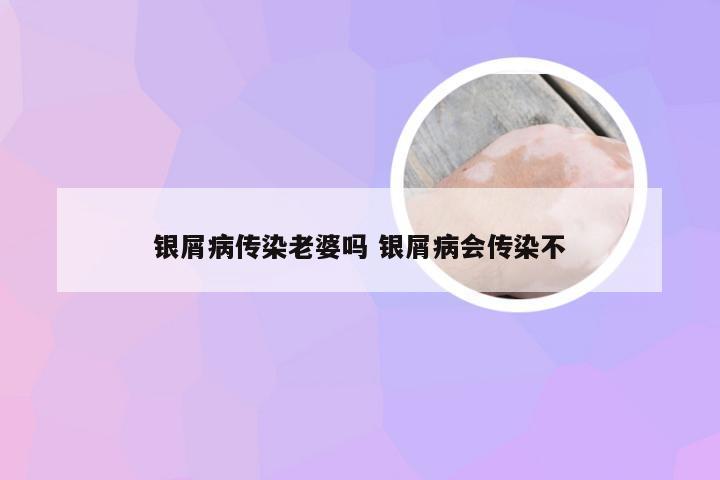 银屑病传染老婆吗 银屑病会传染不