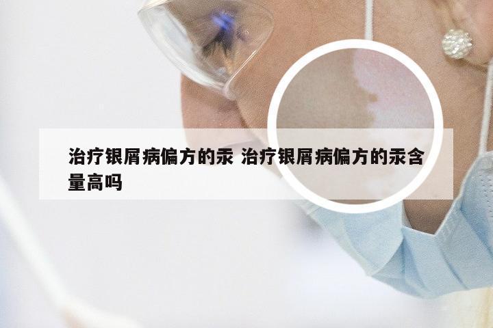 治疗银屑病偏方的汞 治疗银屑病偏方的汞含量高吗