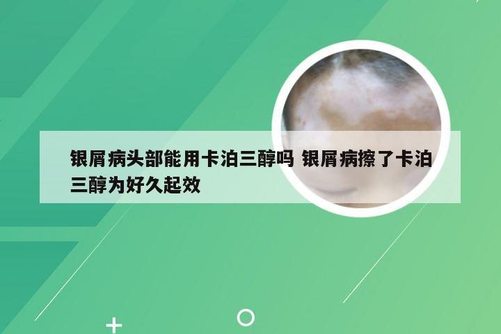 银屑病头部能用卡泊三醇吗 银屑病擦了卡泊三醇为好久起效