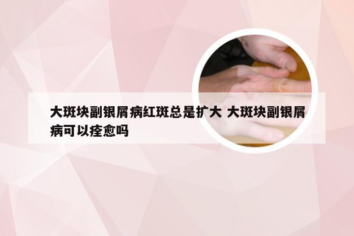 大斑块副银屑病红斑总是扩大 大斑块副银屑病可以痊愈吗