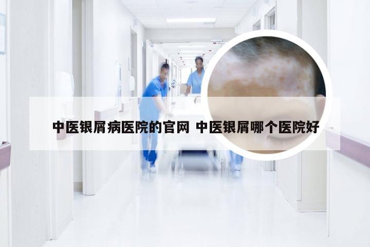 中医银屑病医院的官网 中医银屑哪个医院好