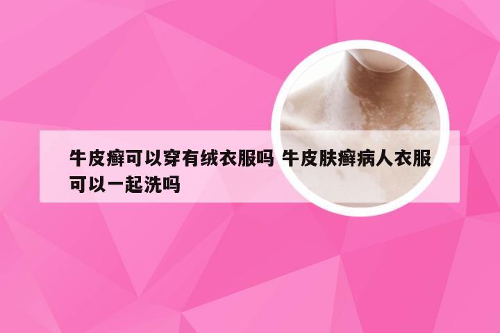 牛皮癣可以穿有绒衣服吗 牛皮肤癣病人衣服可以一起洗吗
