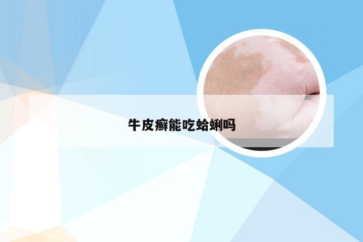 牛皮癣能吃蛤蜊吗