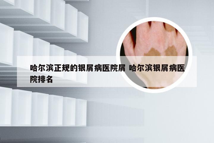 哈尔滨正规的银屑病医院屑 哈尔滨银屑病医院排名