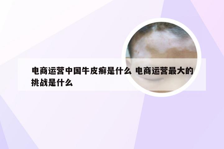 电商运营中国牛皮癣是什么 电商运营最大的挑战是什么