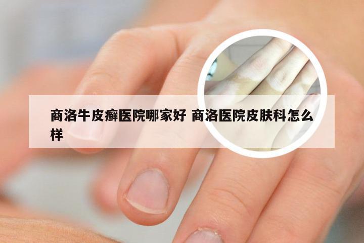 商洛牛皮癣医院哪家好 商洛医院皮肤科怎么样