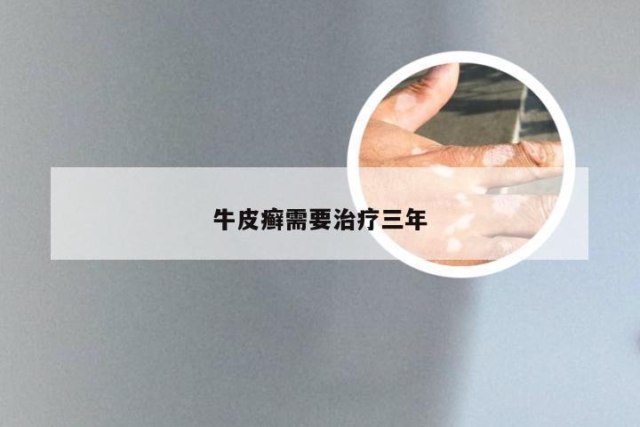 牛皮癣需要治疗三年