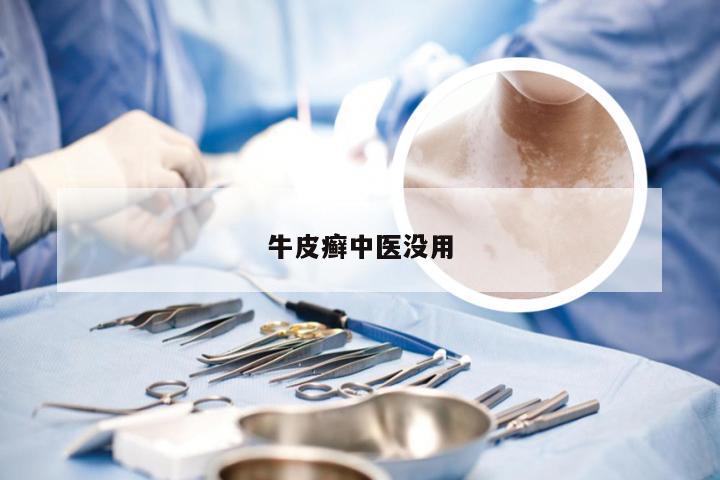 牛皮癣中医没用