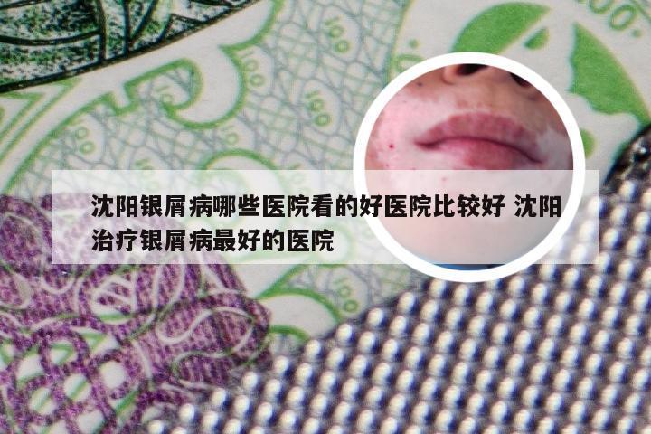 沈阳银屑病哪些医院看的好医院比较好 沈阳治疗银屑病最好的医院