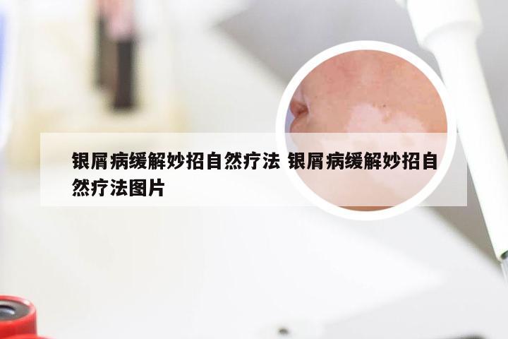 银屑病缓解妙招自然疗法 银屑病缓解妙招自然疗法图片