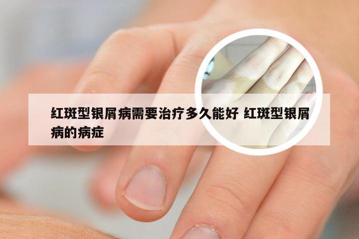 红斑型银屑病需要治疗多久能好 红斑型银屑病的病症