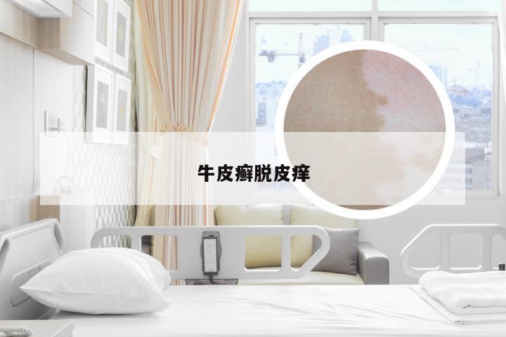 牛皮癣脱皮痒