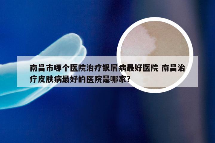 南昌市哪个医院治疗银屑病最好医院 南昌治疗皮肤病最好的医院是哪家?