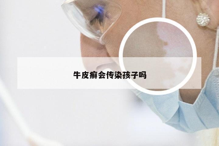牛皮癣会传染孩子吗