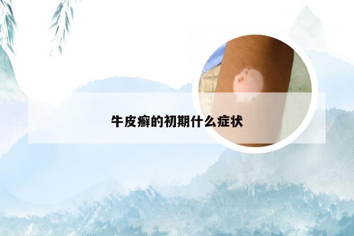 牛皮癣的初期什么症状