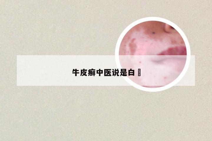 牛皮癣中医说是白痜
