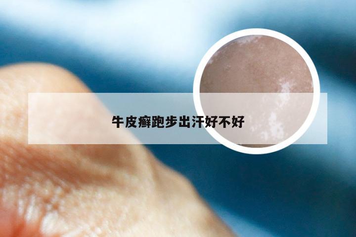 牛皮癣跑步出汗好不好