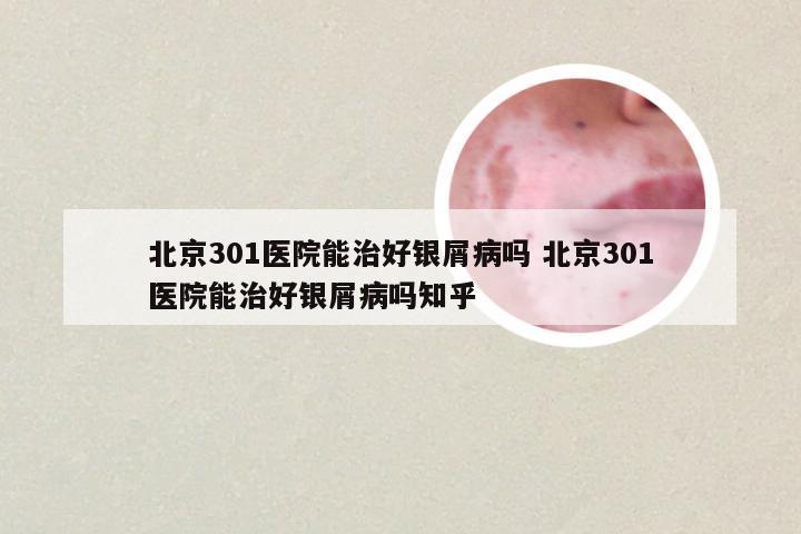 北京301医院能治好银屑病吗 北京301医院能治好银屑病吗知乎