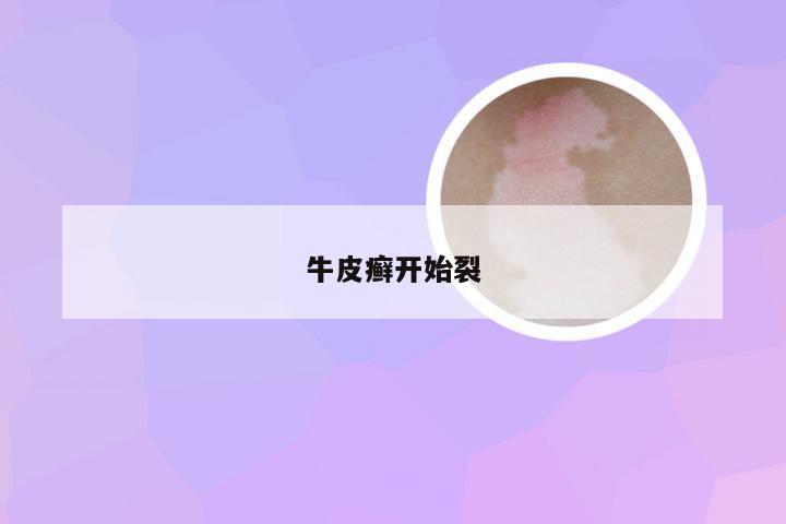牛皮癣开始裂