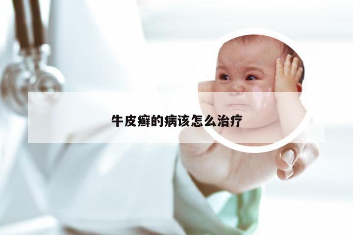牛皮癣的病该怎么治疗