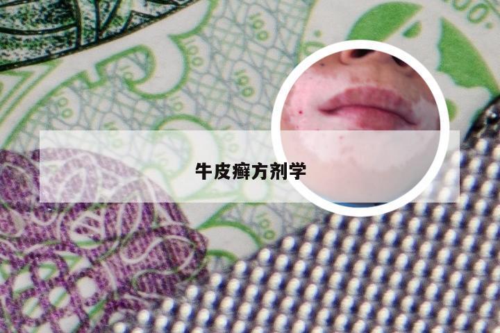 牛皮癣方剂学