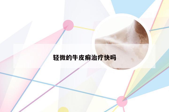 轻微的牛皮癣治疗快吗
