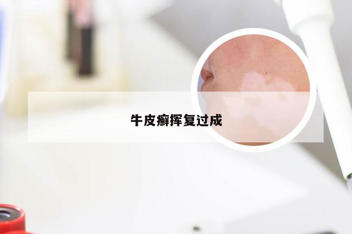 牛皮癣挥复过成